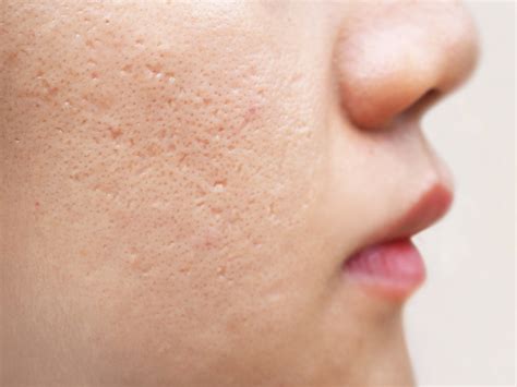Chemical Peels A Miracle Solution For Your Acne Scars Healthwire