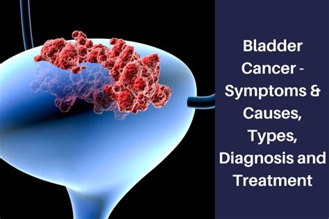 Bladder Cancer Symptoms And Causes Types Diagnosis And Treatment