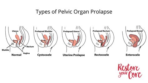 Pelvic Floor Dyssynergia Type 1 Review Home Co