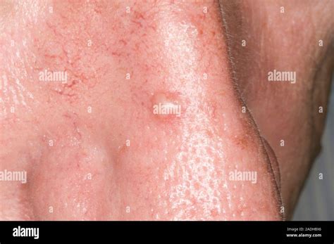 Basal Cell Carcinoma Bcc Or Rodent Ulcer On A 52 Year Old Mans