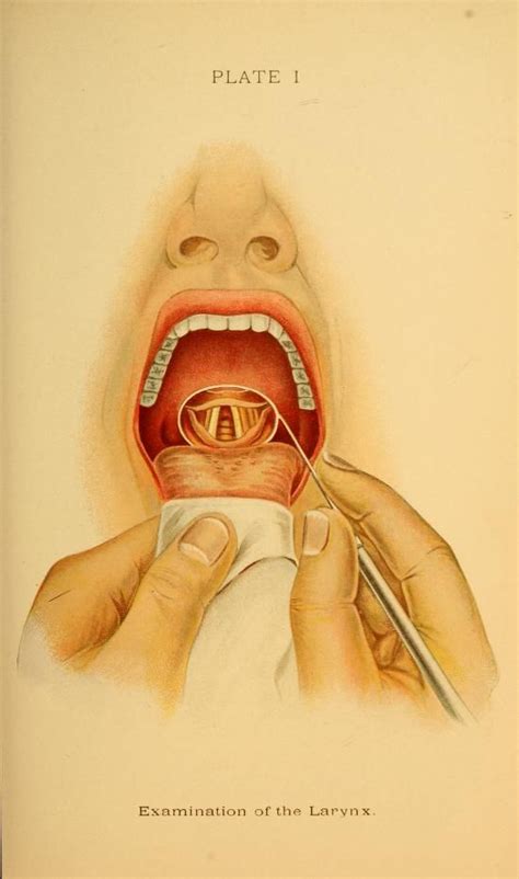 Md ☞ Examination Of The Larynx From A Manual Of Diseases Of The