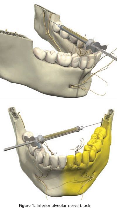 Lingual Nerve Block Anestesia En Odontologia Escuela De Higiene