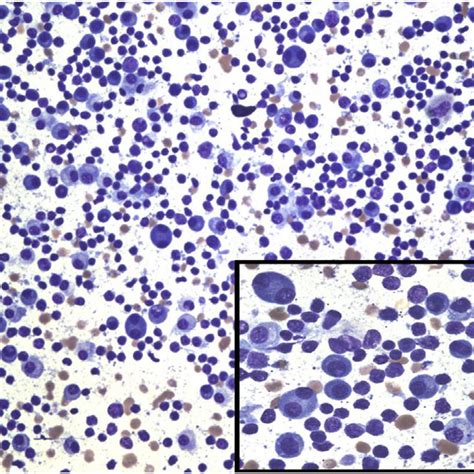 Bone Marrow Smear Showed Numerous Lymphoplasmacytic Cells Download