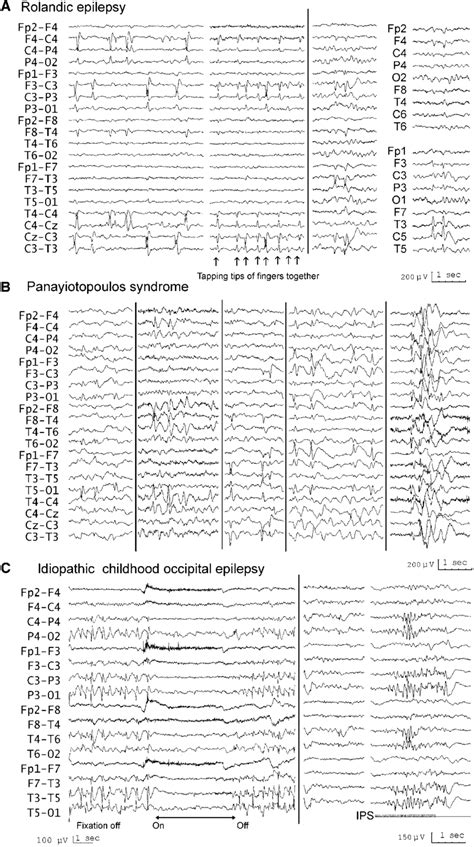 Onset of symptoms begins between the ages of 3 and 13 years and peaks during ages 7 to 8 years. Interictal EEG in rolandic epilepsy (top), PS (middle) and ...