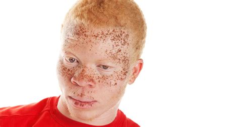 Skin Cancer On Black People