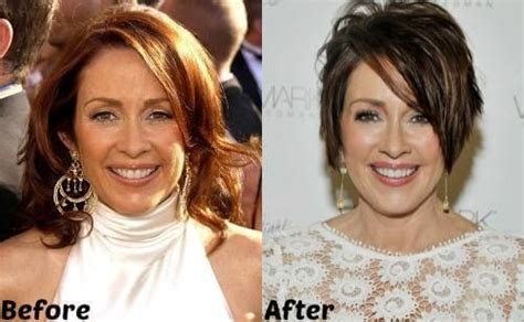 Patricia Heaton Plastic Surgery Before And After Photos Patricia