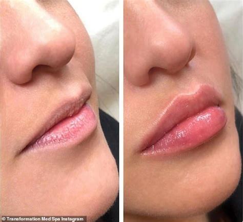 Lip Threading Is The Trend Tipped To Take Over Fillers Lip Fillers