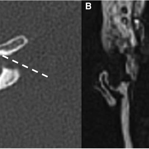Bone Ct A And T2 Weighted Mri B Imaging Of A Right Cochlear