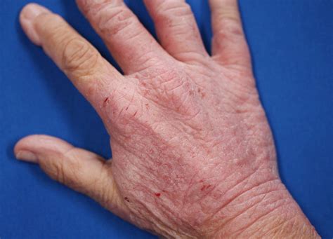 Skin Rashes In Adults On Hands Images And Photos Finder