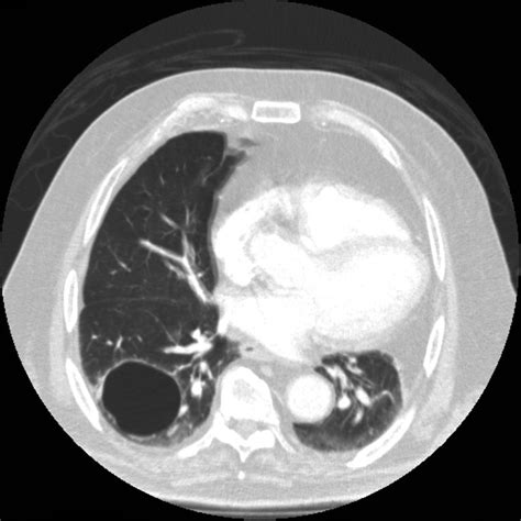 Lung Cyst Image