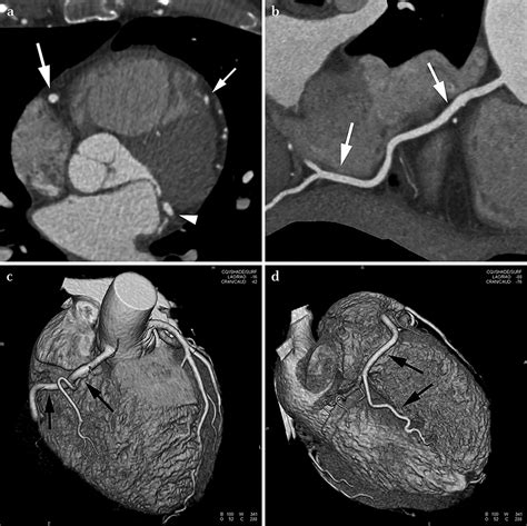Cardiac Imaging In The Patient With Chest Pain Coronary Ct Angiography