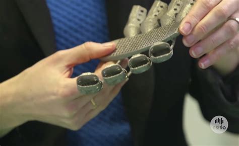 Cancer Patient Receives Worlds First 3d Printed Rib Cage In New