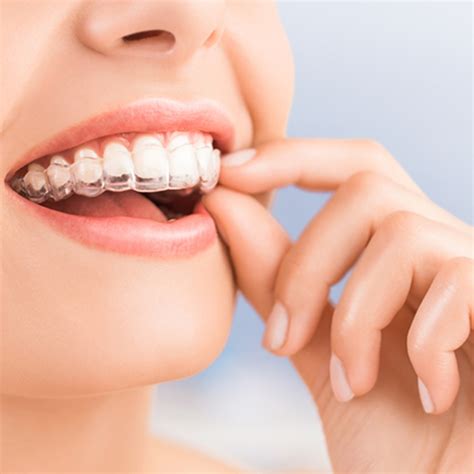Total orthodontics is a group of specialist dental practices that focus solely on orthodontic care. Invisalign & Invisalign Teen | Dental solutions for the ...