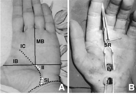 Photographs Illustrating The Double Mini Skin Incision Technique A