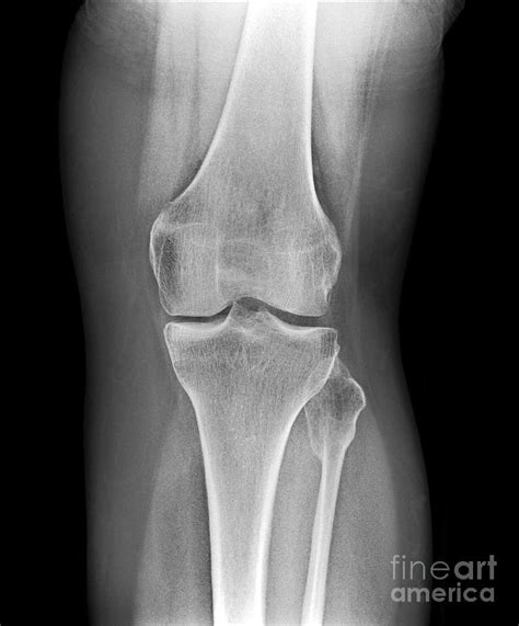Removed Kneecap X Ray Photograph By Science Photo Library Fine Art