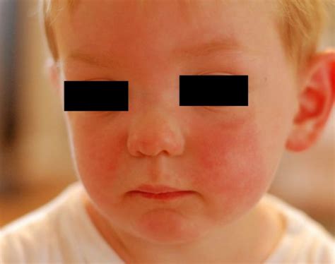 Fifth Disease Pictures Symptoms Treatment Causes Diagnosis Hubpages