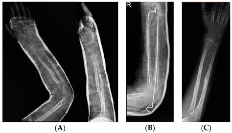 Jcm Free Full Text Forearm Fracture Nonunion With And Without Bone