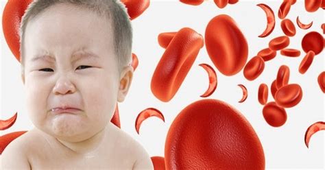 Anemia Falciforme Doença Causada Por Mutação Genética Saúde