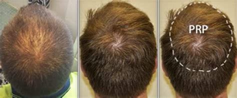 Always consult your doctor before starting or changing any medication. Microneedling For Hair Loss Results