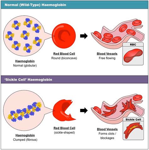 Sickle Cell Anemia Causes Fenetics Symptoms Diagnosis Treatment And Prognosis