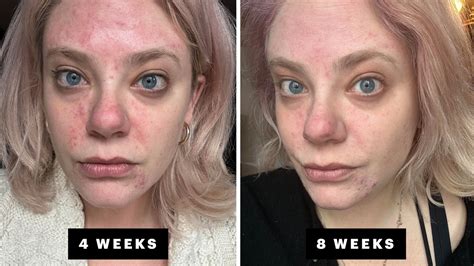 My Hormonal Acne Journey With Winlevi The New Spironolactone