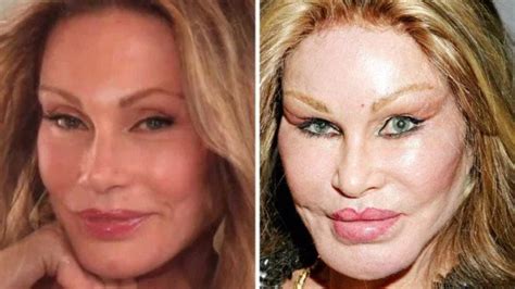 Times Celebrities Plastic Surgeries Turned To Disasters