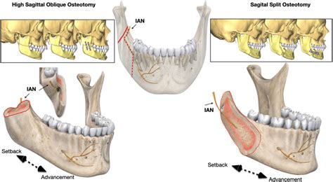 Schematic Comparison Of High Sagittal Split Osteotomy Hsoo Left And