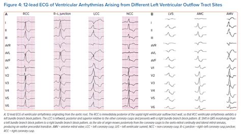 Electrocardiogram Ecg Diagnosis Of Ventricular Arrhythmias