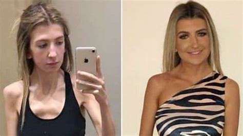 Recovering Anorexic 19 Shares Astonishing Transformation Photos To