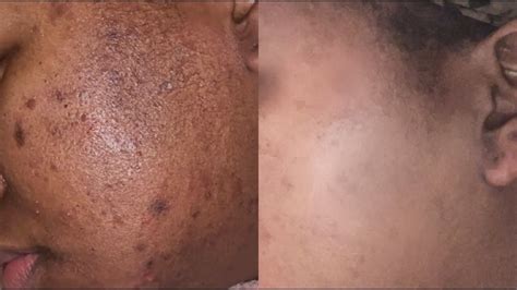 How To Fade Acne Scars And Hyper Pigmentation In One Month Skin Care