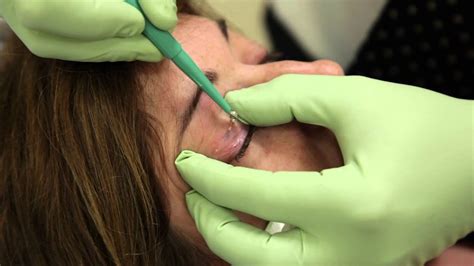How To Remove Skin Tags From Eyelids Using A Snip Excision YouTube