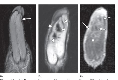 Figure 12 From Mr Imaging Of Nonmalignant Penile Lesions Semantic
