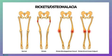 Osteomalacia Symptoms Causes Risk Groups Prevention And Treatment