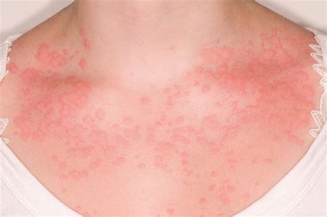 Chronic Spontaneous Urticaria Clinical Features Diagnosis And Management The Pharmaceutical