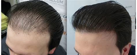 Tips For Getting The Best Out Of Your Hair Transplant Scientific