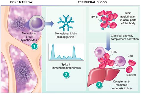 Hemato Free Full Text Cold Agglutinin Disease A Distinct Clonal B