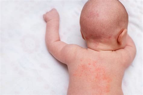 Itchy Eczema In Children Finally Gets Relief