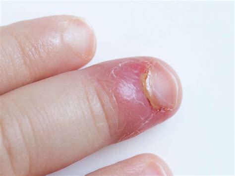 Paronychia Causes And Treatment Of An Infected Nail