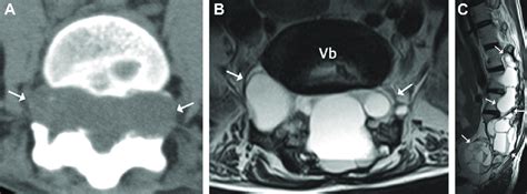 Large Multilocular Aneurysmal Bone Cyst Throughout The Lumbar Spine