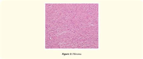 Figure 3 From Surgical Management Of Fibroepithelial Polypsof The