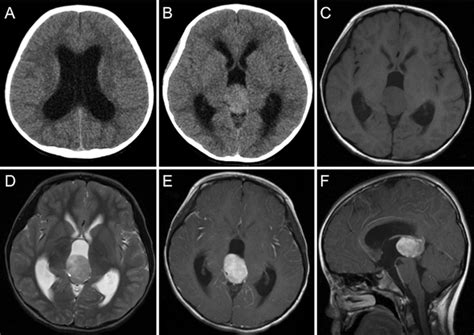Admission Ct Showed Dilation Of Bilateral Ventricles A And A Pineal