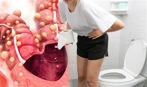 Bowel Cancer Symptoms Five Signs To Look For When You Go To The Toilet