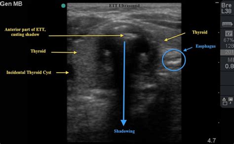 Use Ultrasound For Confirmation Of Endotracheal Tube Intubation Sinai Em