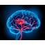 Isquemia Cerebral  Causas E Tratamentos Biosom