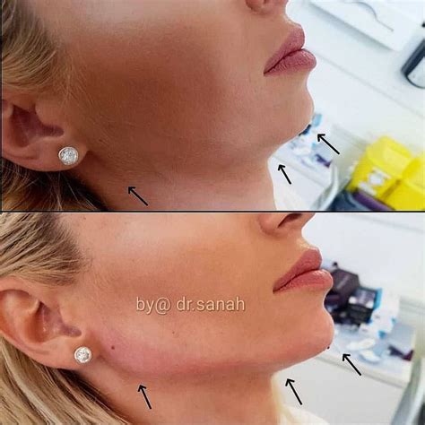 Jawline Contouring Hello New Sharp And Chiseled Jawline This Patient