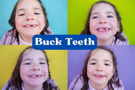 Buck Teeth Causes Symptoms Diagnosis Health Risk And Treatment