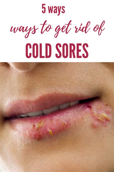 How To Get Rid Of Cold Sores Beauty Services At Home Cold Sore