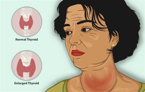 What Is The Difference Between Goiter And Thyroid Nodule Compare The
