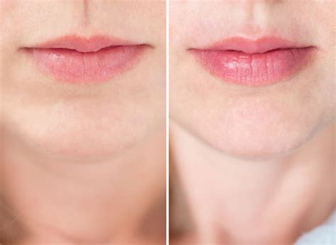Reviewed The Pmd Kiss Lip Plumping System For Fuller Looking Lips No Injections Required