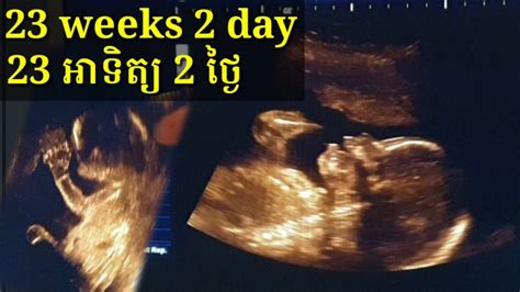 អេកូផ្ទៃពោះ 23អាទិត្យ 2ថ្ងៃ Pregnancy Ultrasound 23weeks 2day By Drbun